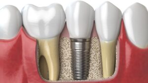 Read more about the article Tooth Replacement with Single Tooth Implants or Bridges in Chattanooga, Tennessee