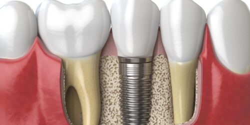Tooth Replacement with Single Tooth Implants or Bridges in Chattanooga, Tennessee
