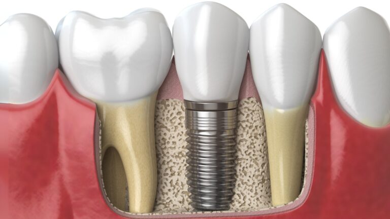 Tooth Replacement with Single Tooth Implants or Bridges in Chattanooga, Tennessee