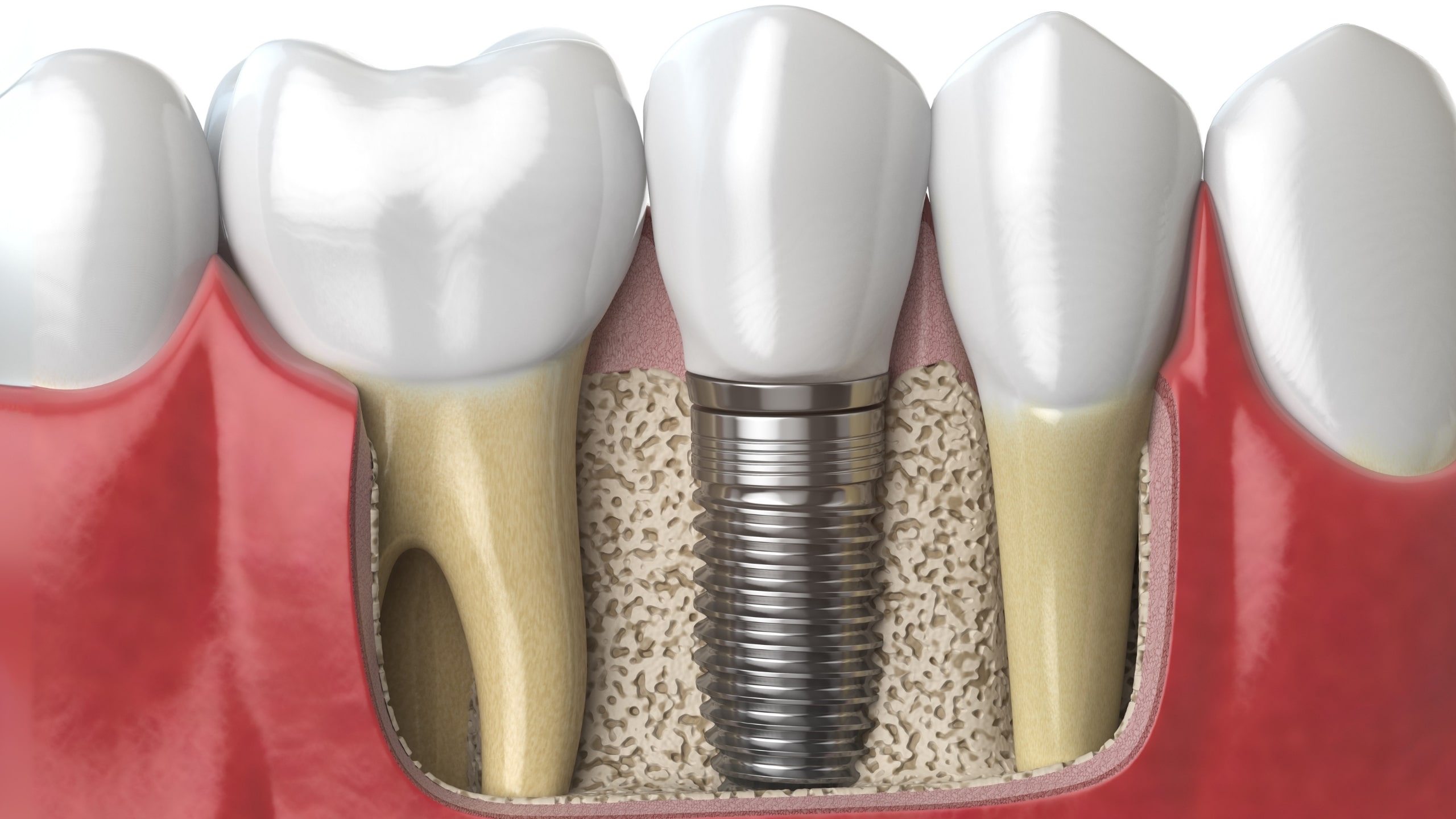 You are currently viewing Tooth Replacement with Single Tooth Implants or Bridges in Chattanooga, Tennessee