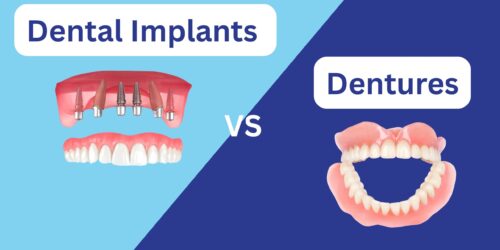 Dental Implants or Dentures: How to Choose The Right Replacement for You