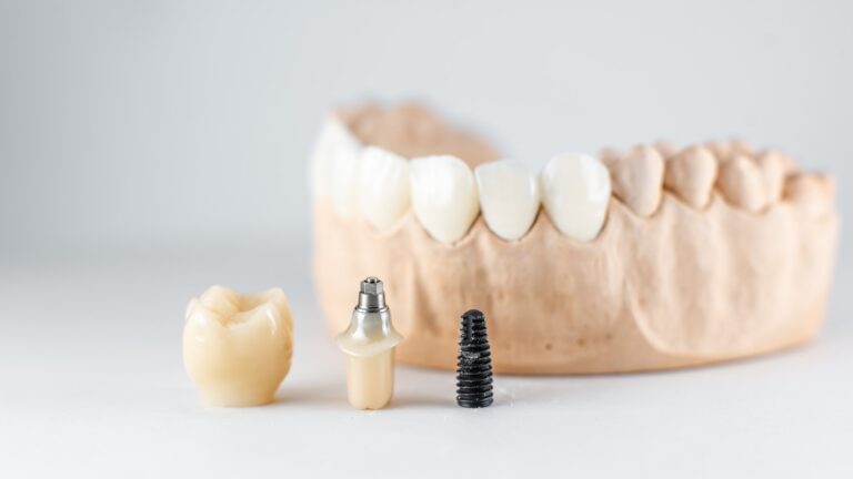 The 3 Parts of a Dental Implant Explained-min