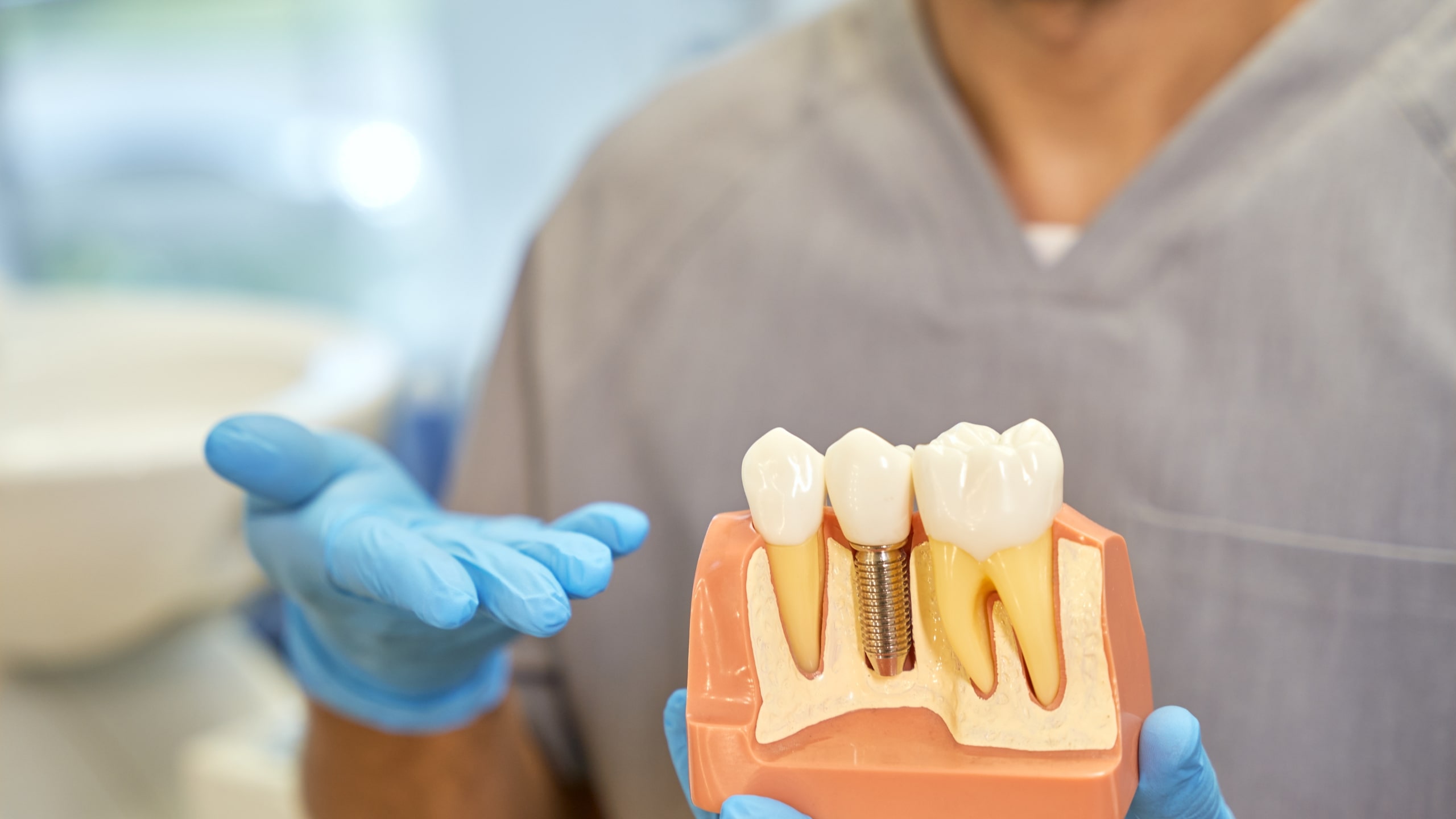 You are currently viewing The Beginner’s Guide to Full Mouth Dental Implants