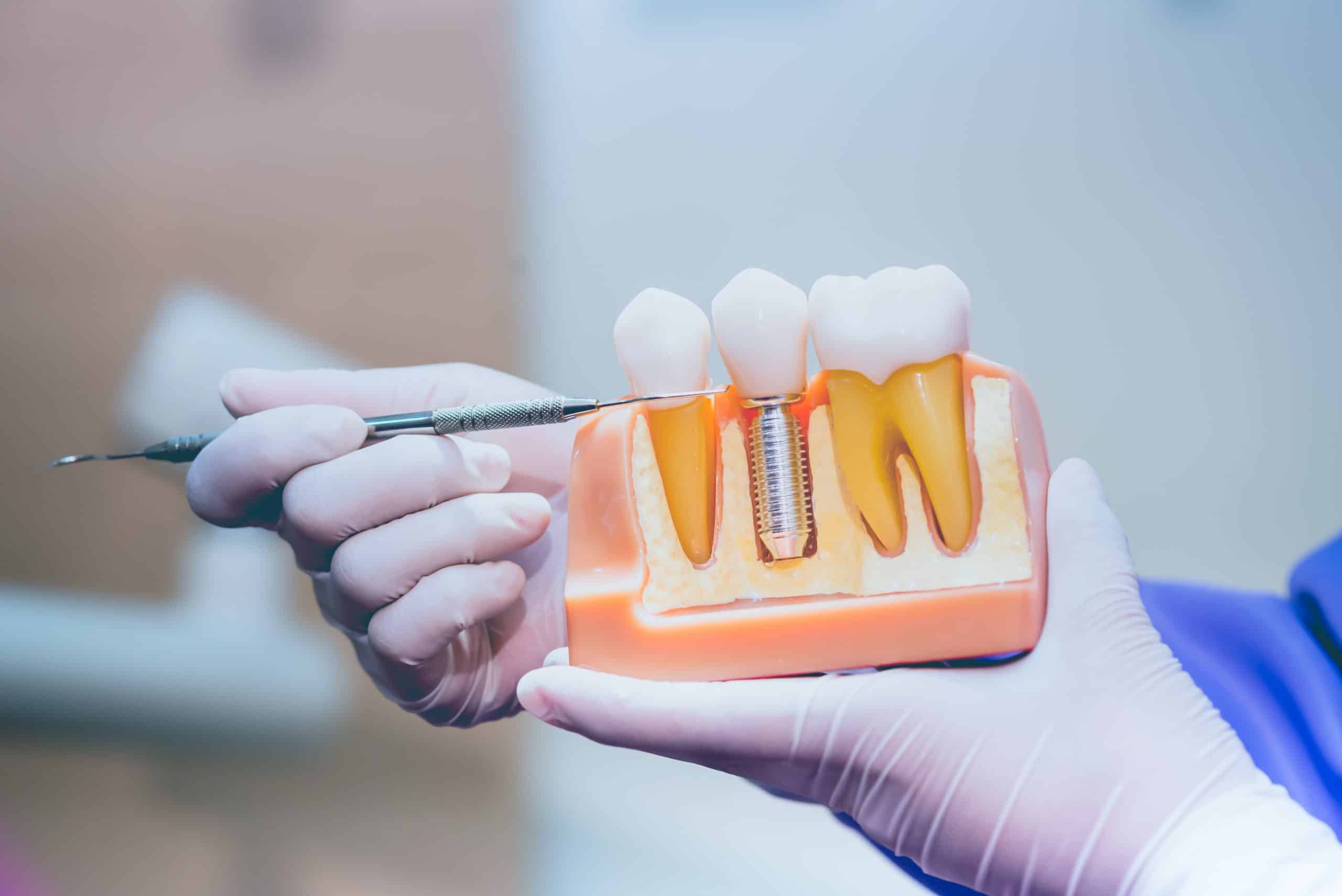 You are currently viewing Dental Implants vs. Bridges