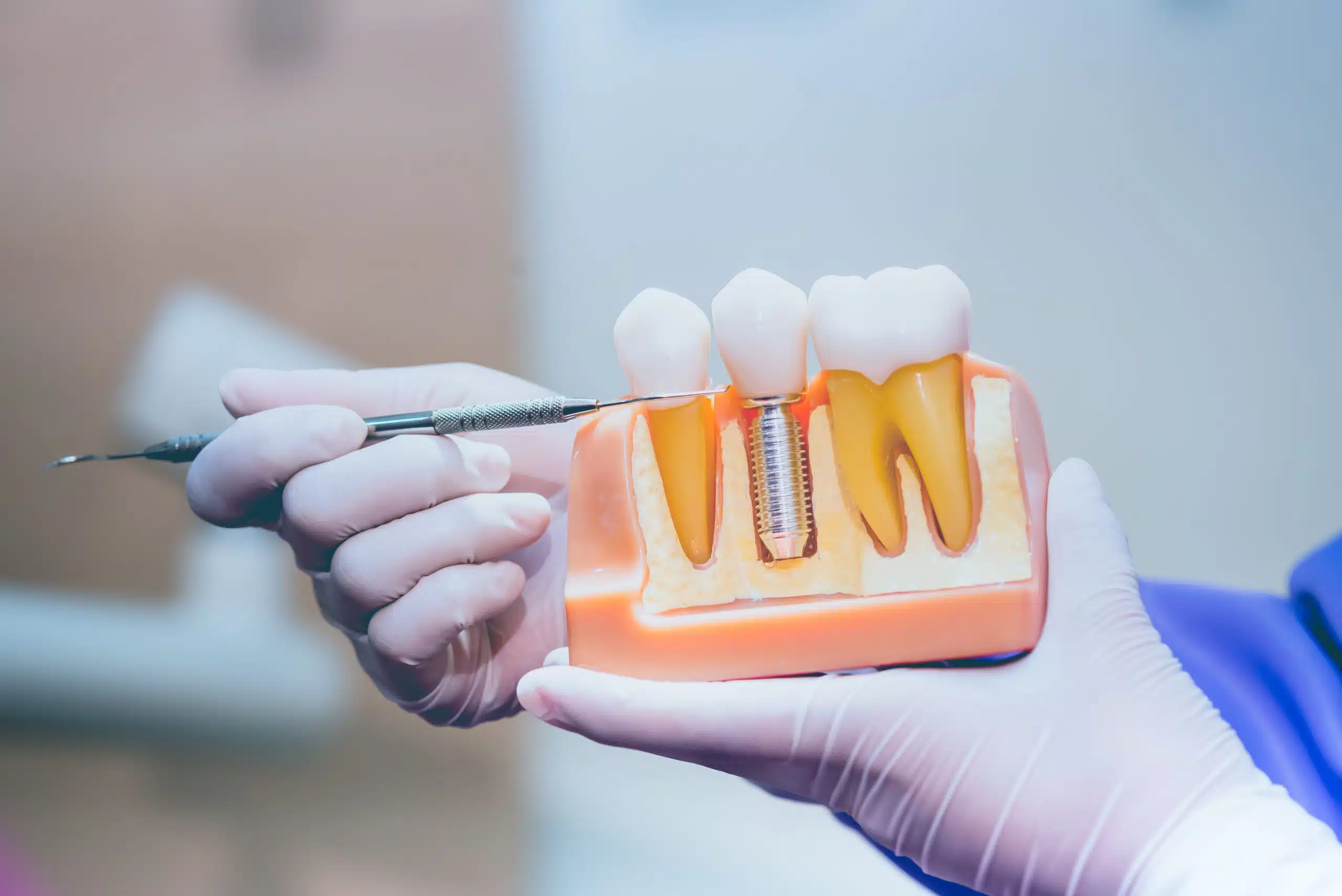 Read more about the article Dental Implants vs. Bridges