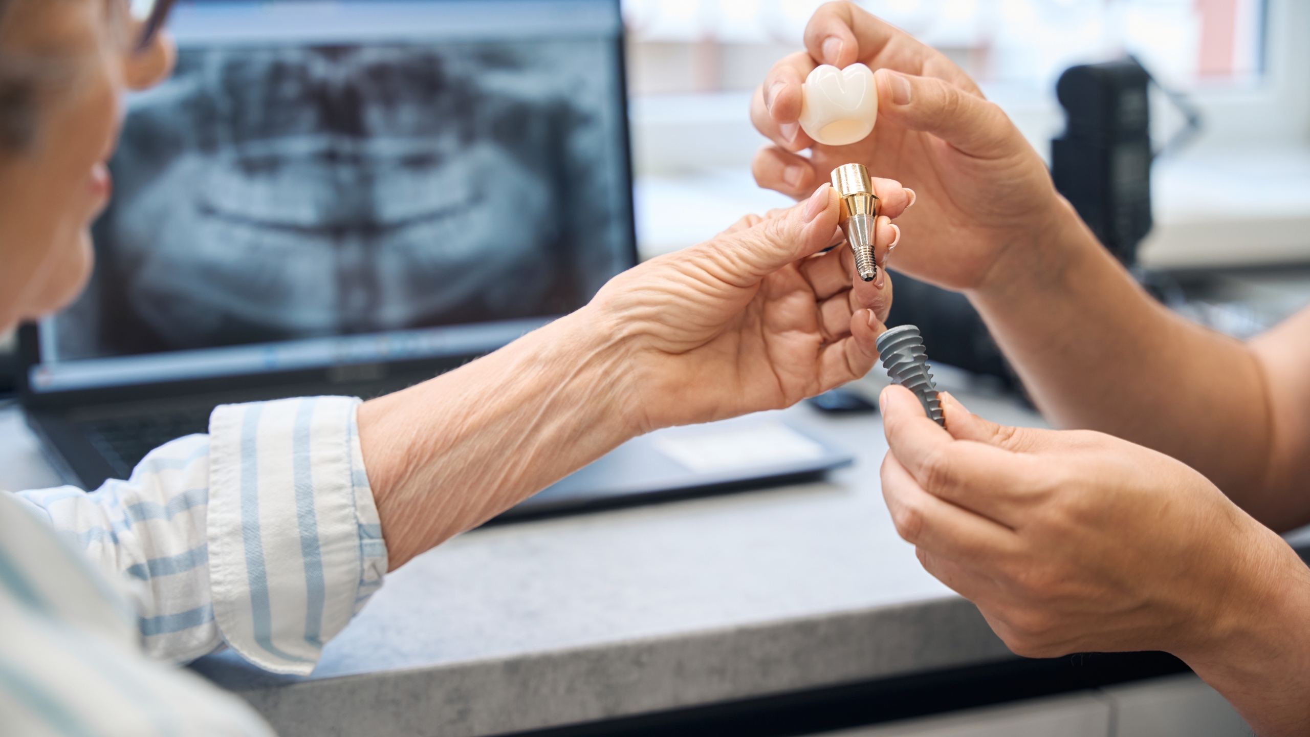 You are currently viewing Benefits of Single-Tooth Dental Implants
