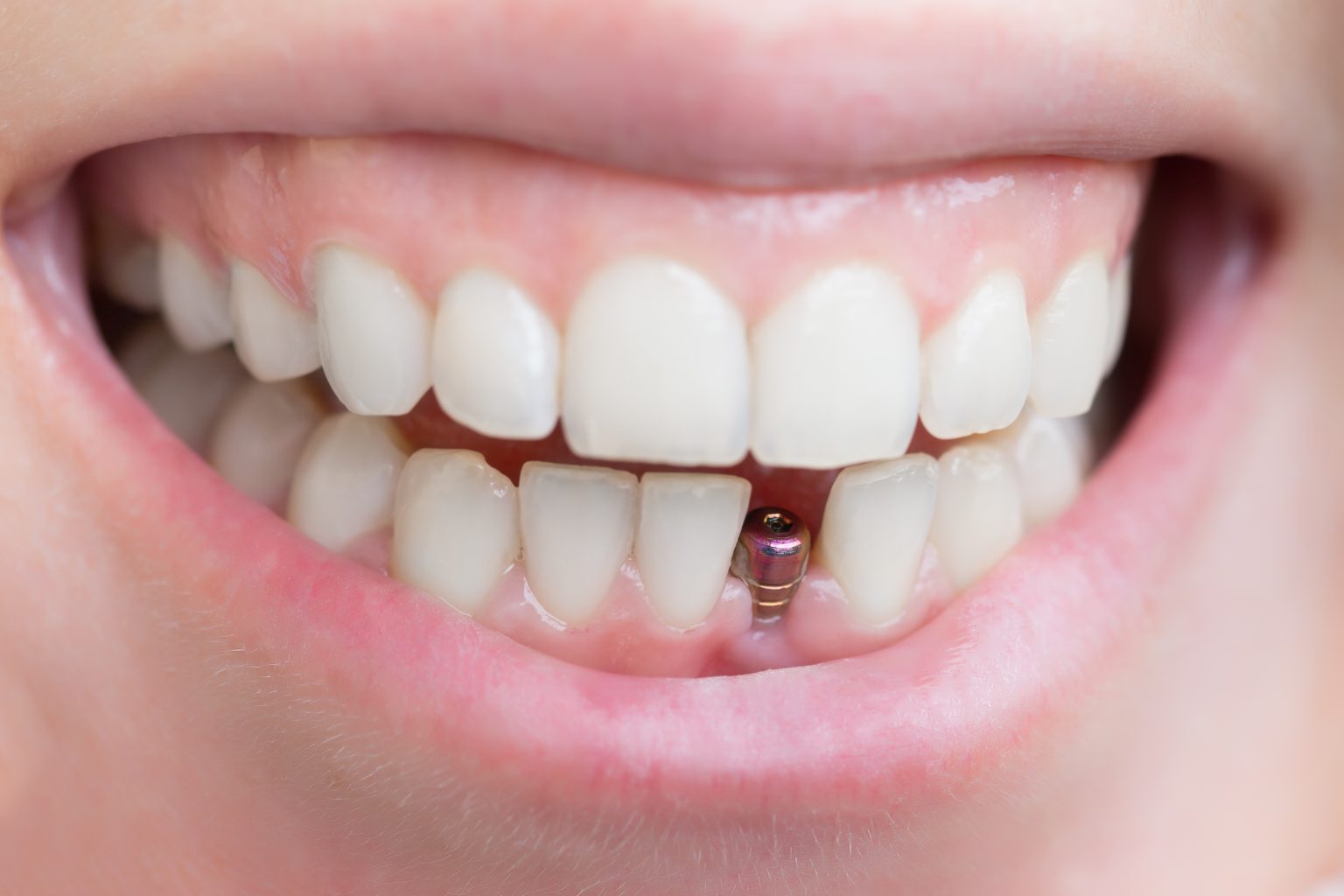 Single Tooth Implants: Replacing a Missing Tooth?