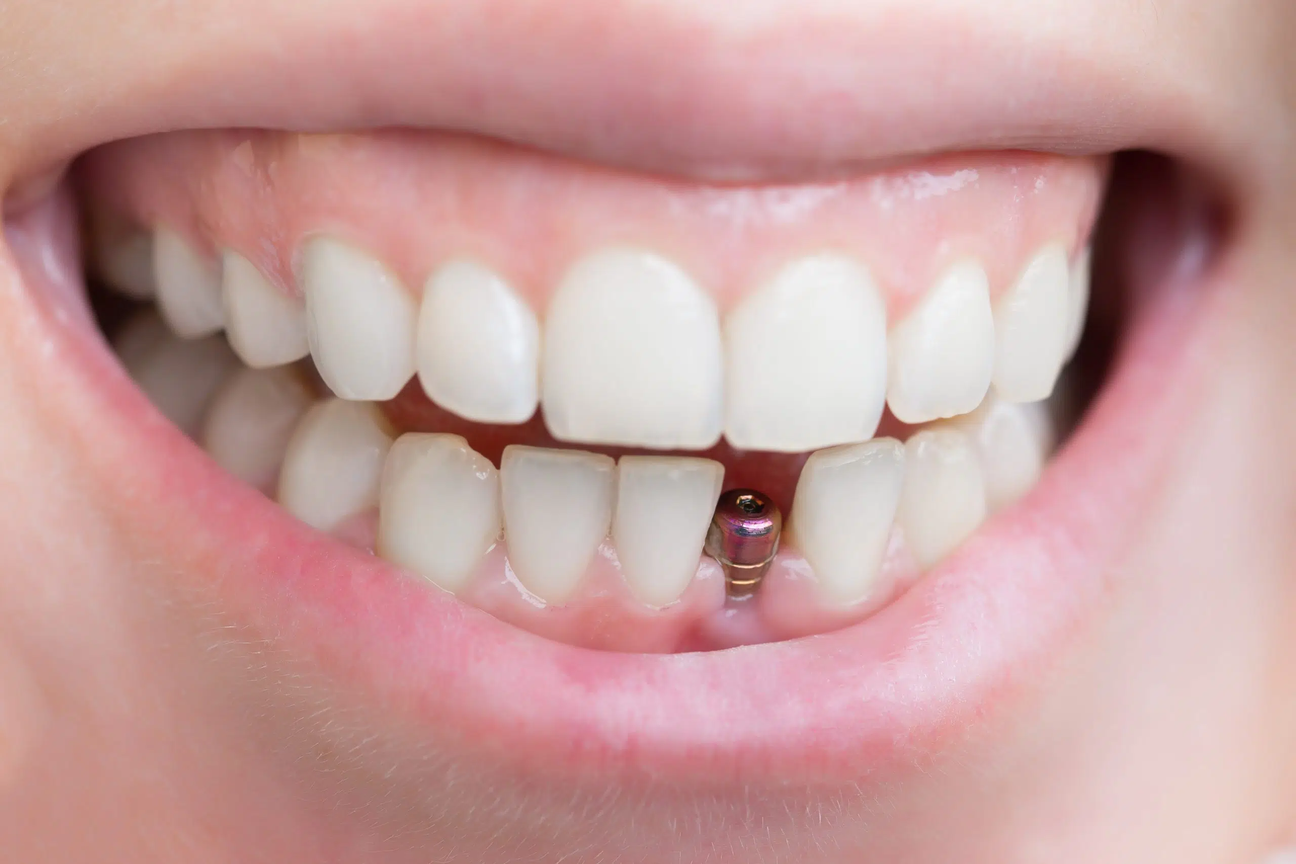 Read more about the article Single Tooth Implants: Replacing a Missing Tooth?