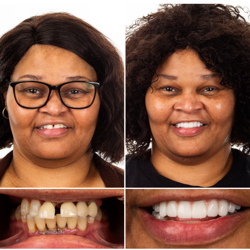 Female Dental Implant Patient Transformation