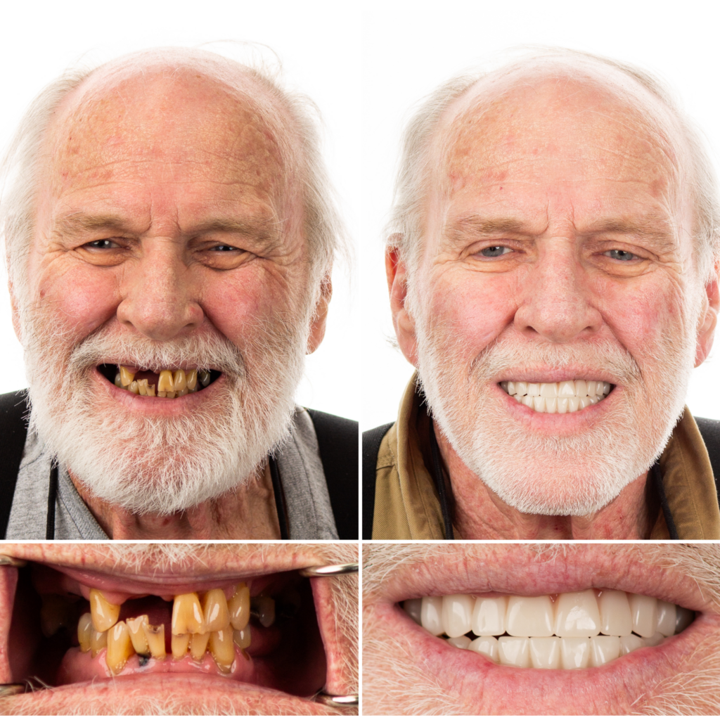 Male Dental Implant Transformation