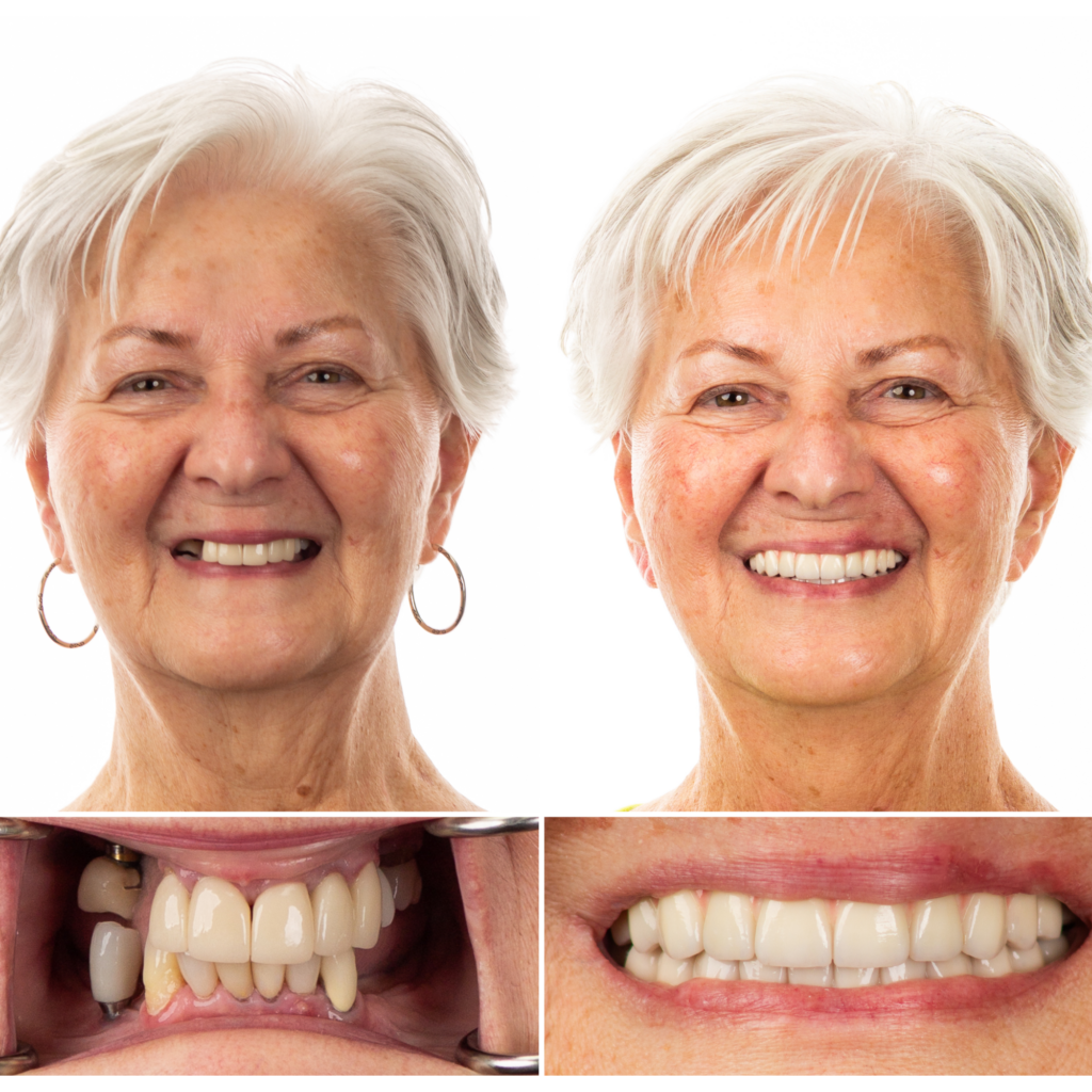 Female Dental Implant Transformation