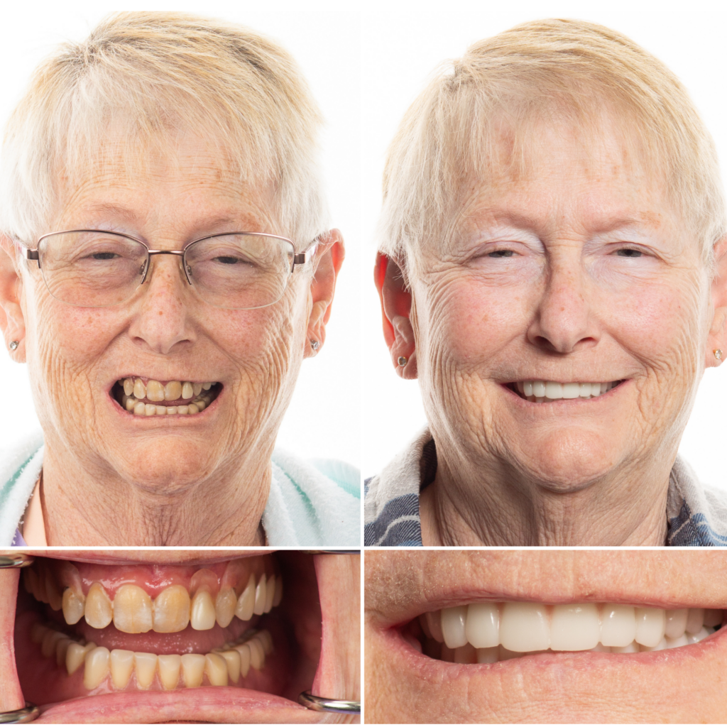 full mouth dental implants in chattanooga