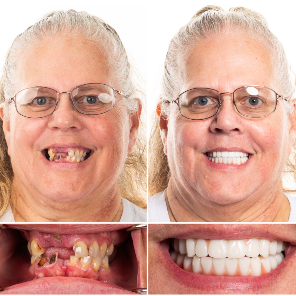 smile transformation implant