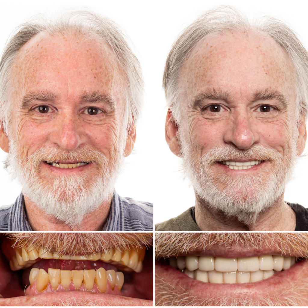 male dental implant transformation