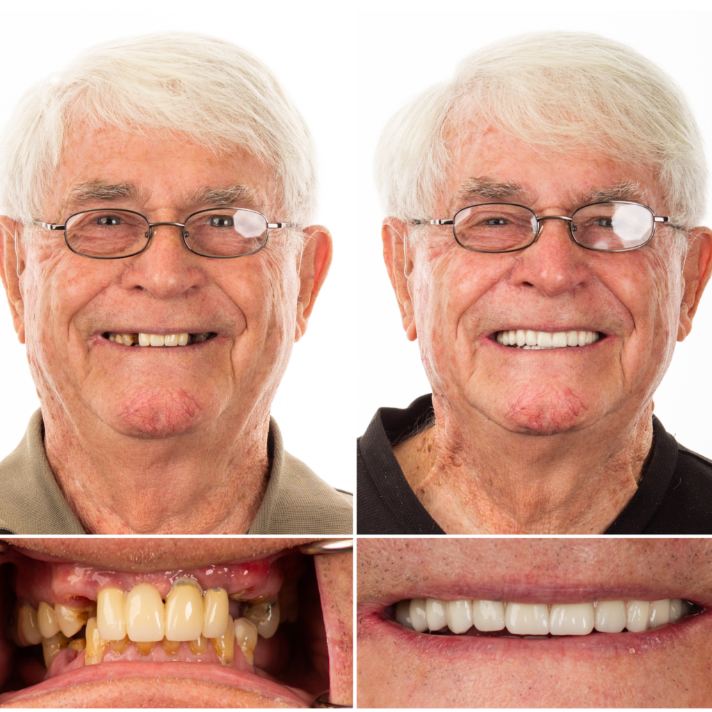 male dental implant patient
