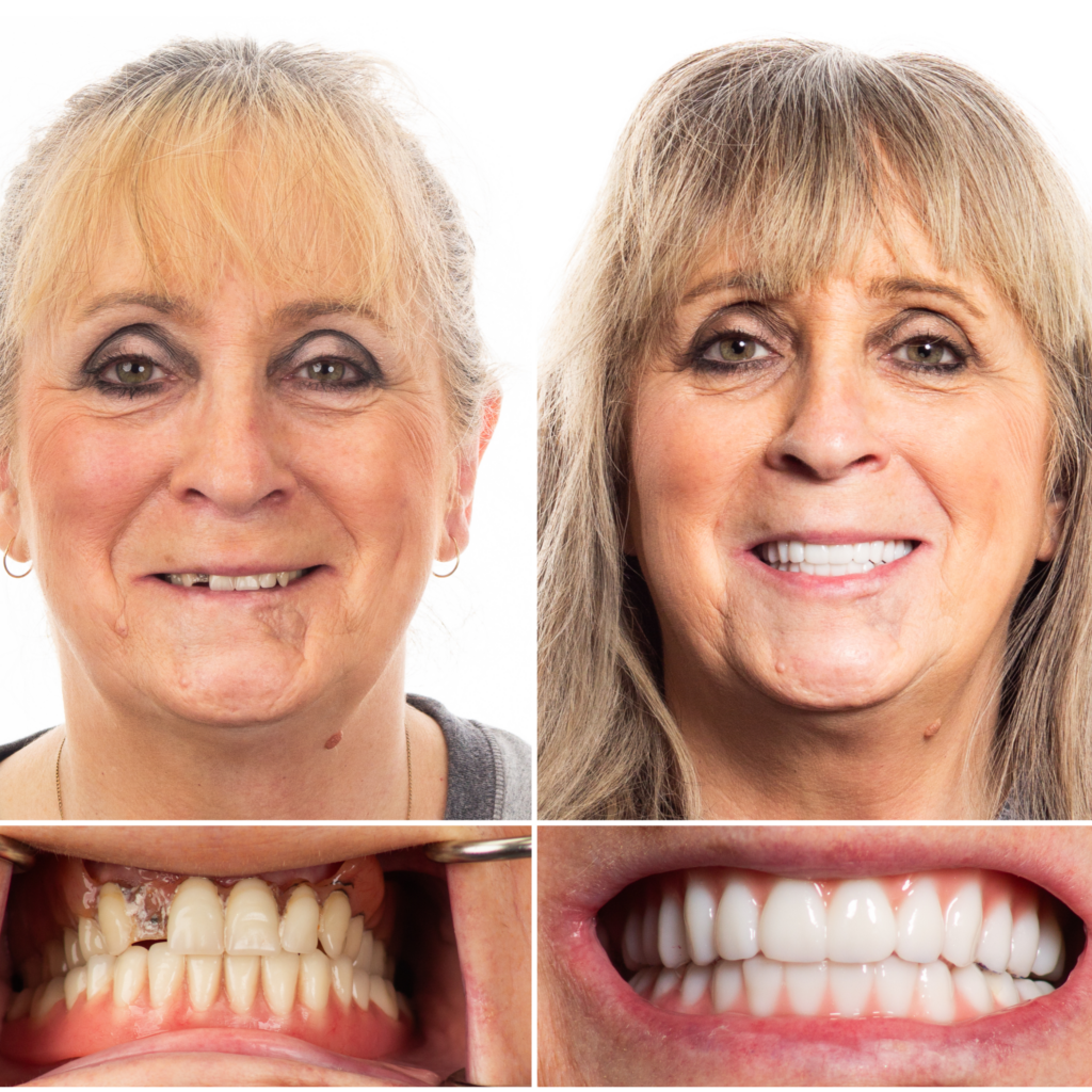 one day teeth implants