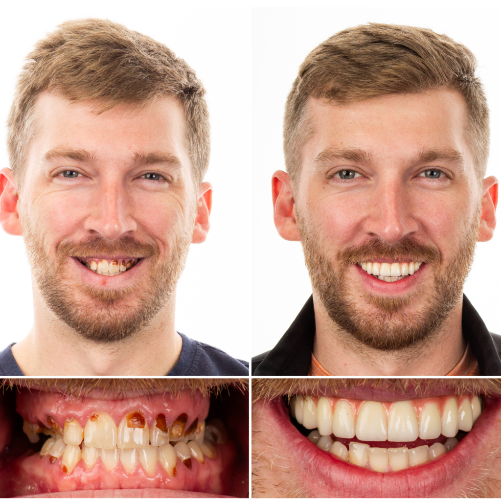 male all on 4 smile transformation