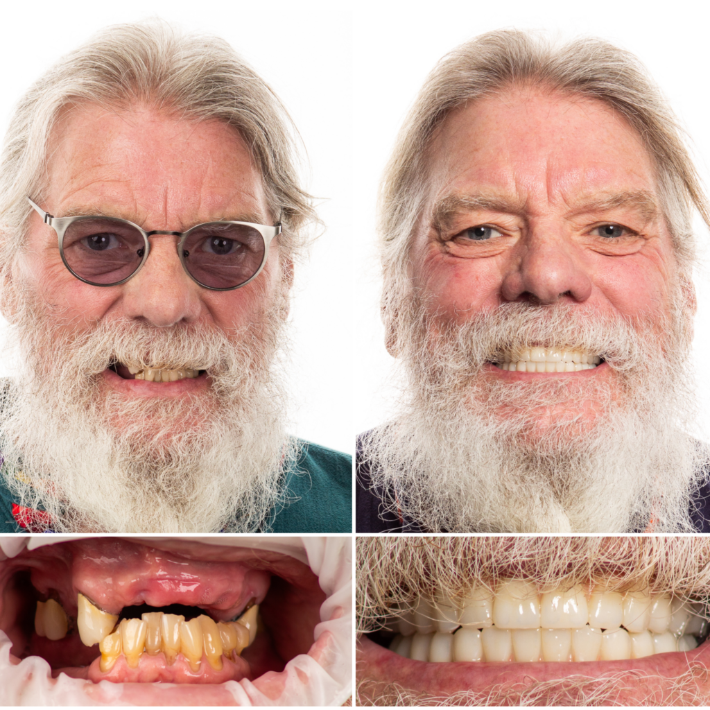 real before and after dental implants