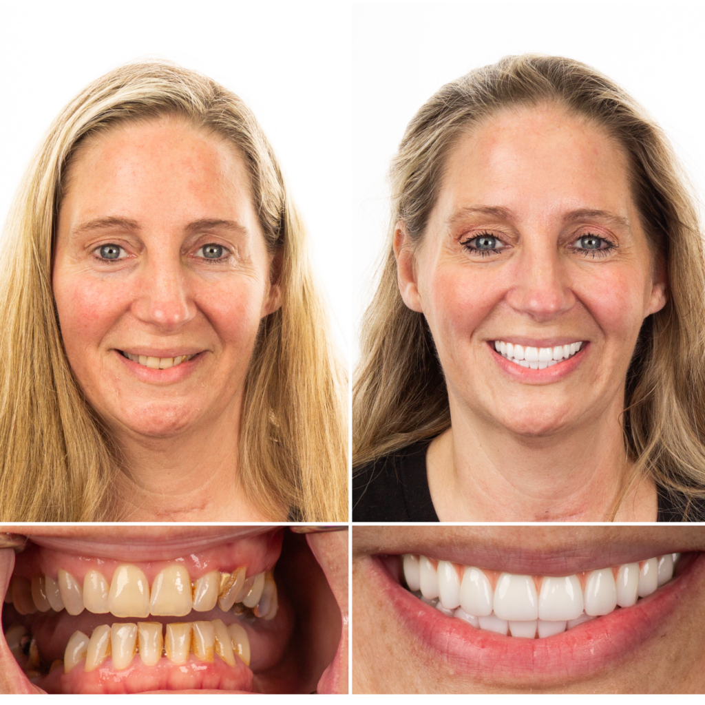 teeth implants chattanooga