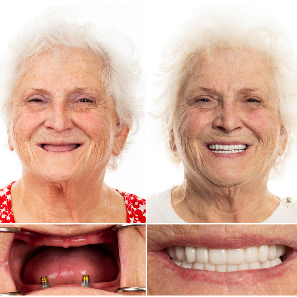 dental implants for seniors