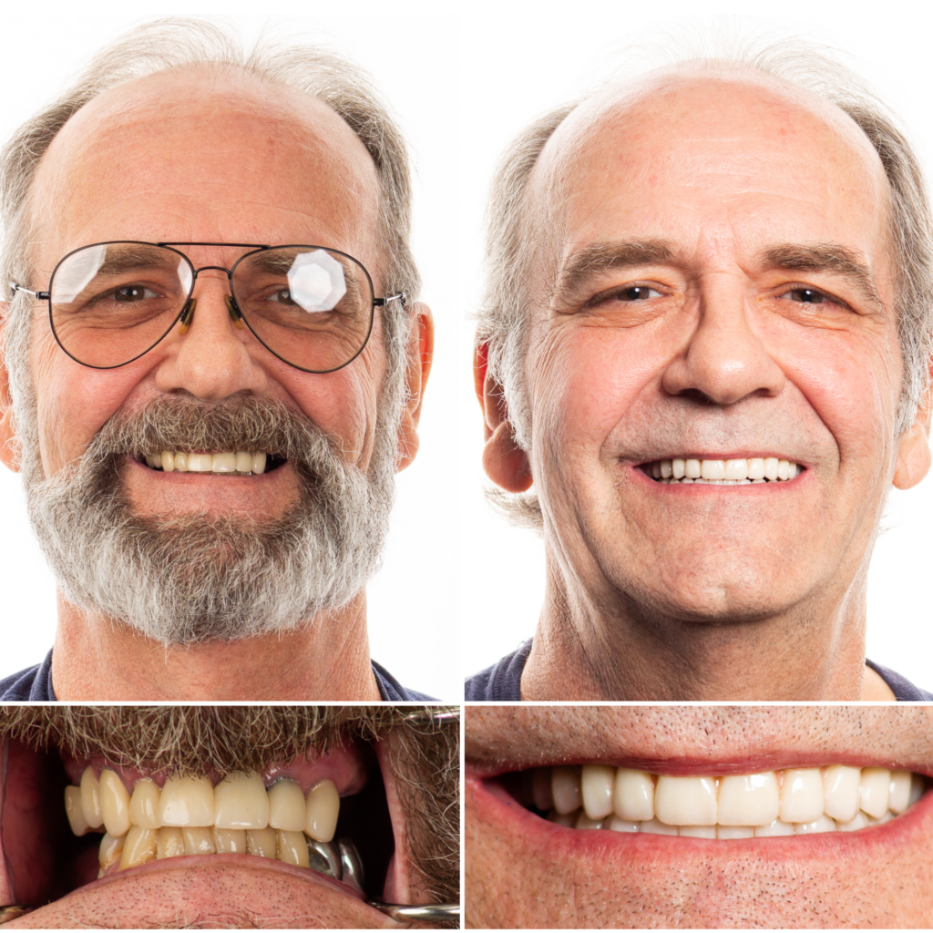 Male Full Mouth Dental Implant Transformation