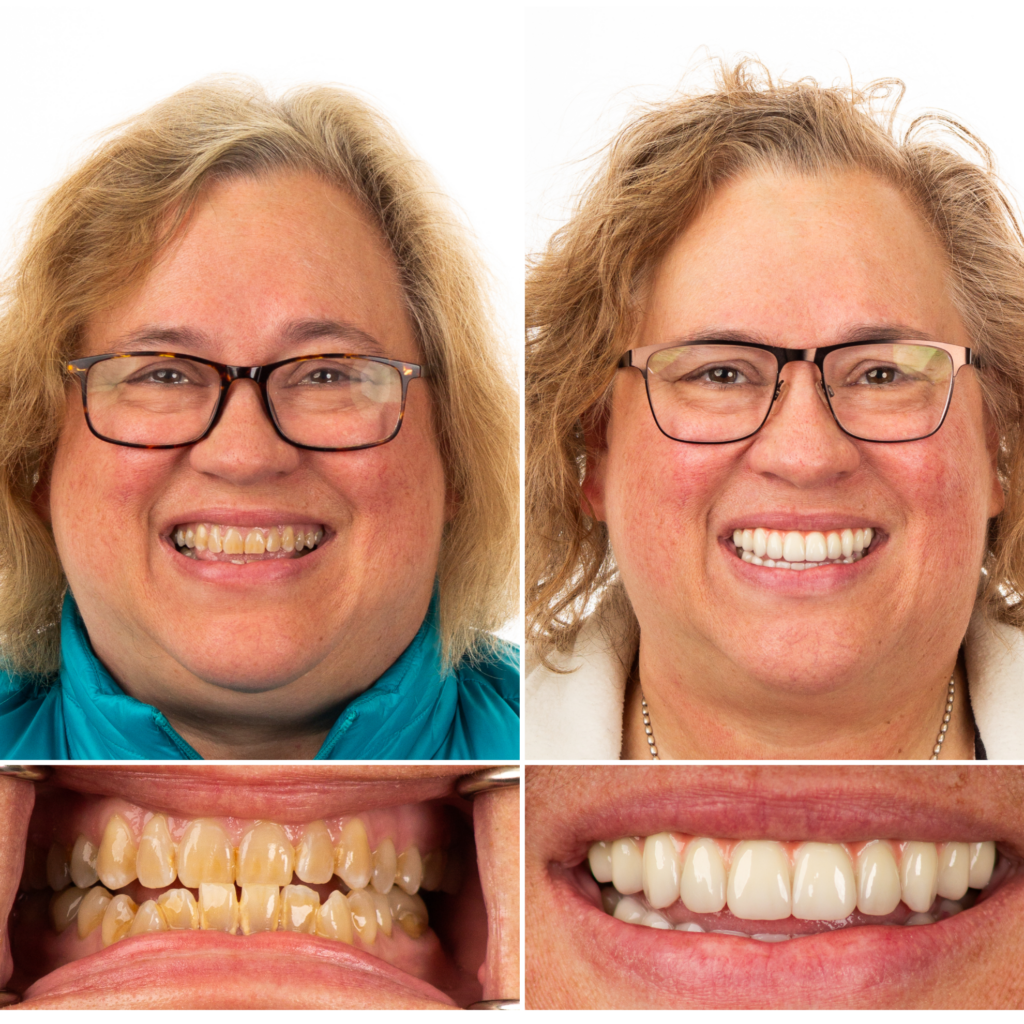 Chatt Implant Center Full Mouth Transformation