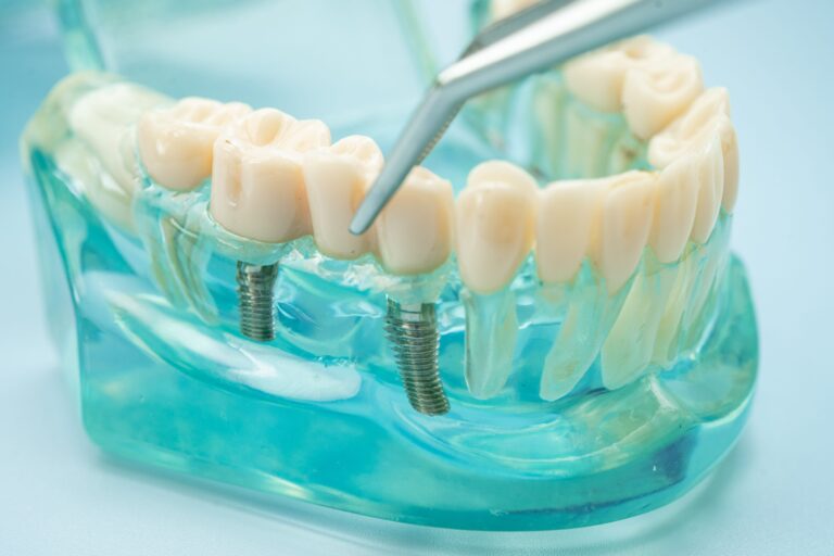 Cost of Full Mouth Dental Implants in Chattanooga, TN