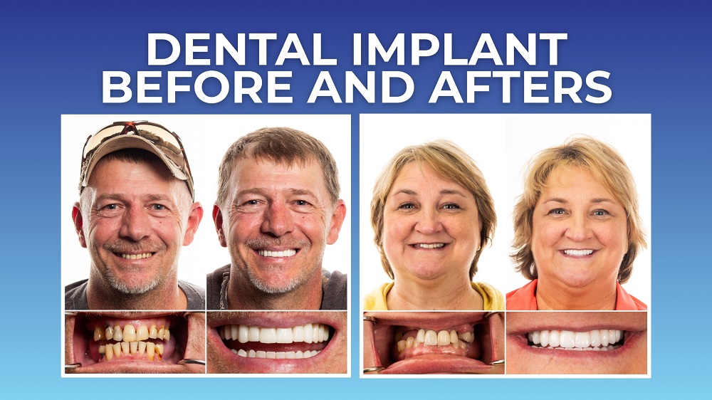 You are currently viewing Dental Implants Before and After Transformations
